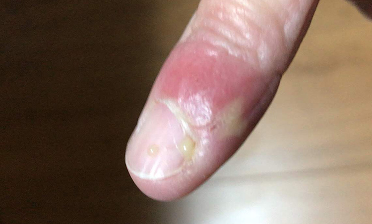 ひょうそによる指先状況：治療から3日経過した画像：膿が出ている様子